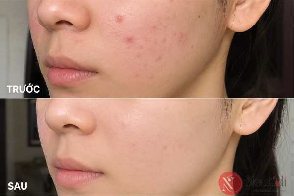 TOP 11 serum trị mụn cho da dầu tốt nhất 2026 (bác sĩ da liễu khuyên dùng) 8 Trải nghiệm SVR serum giảm mụn viêm và gom cồi mụn