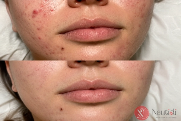 TOP 11 serum trị mụn cho da dầu tốt nhất 2026 (bác sĩ da liễu khuyên dùng) 7 Hiệu quả của serum trị mụn giá rẻ The Ordinary Salicylic Acid 2% Solution