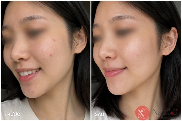TOP 11 serum trị mụn cho da dầu tốt nhất 2026 (bác sĩ da liễu khuyên dùng) 13 Vichy serum cho da mụn nhạy cảm