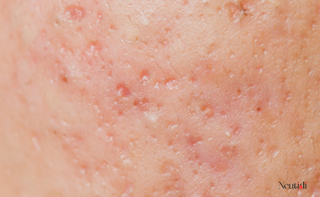 Có nên dùng niacinamide để làm mờ sẹo?