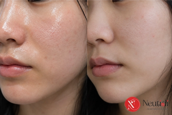 Dùng niacinamide bao lâu thì da bớt dầu nhờn?