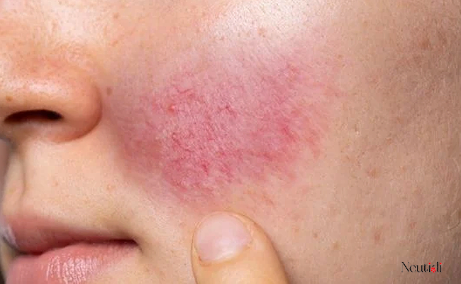 Hiện tượng đỏ da khi sử dụng niacinamide