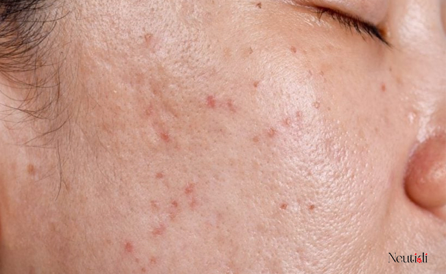 Nguyên nhân dùng kem dưỡng vẫn bị đổ nhiều dầu nhờn