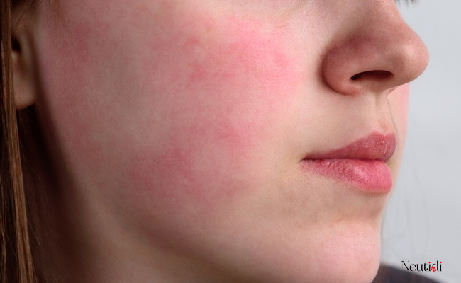 Những nguyên nhân dùng niacinamide bị đỏ da