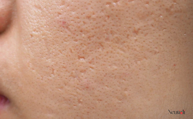 Giải đáp thắc mắc: Niacinamide có làm mờ sẹo không?