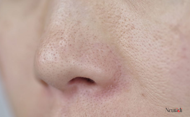 Trả lời cho câu hỏi: Niacinamide có giúp thu nhỏ (se khít) lỗ chân lông không?