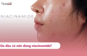Da dầu có nên sử dụng niacinamide?