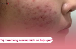 Niacinamide trị mụn được không?
