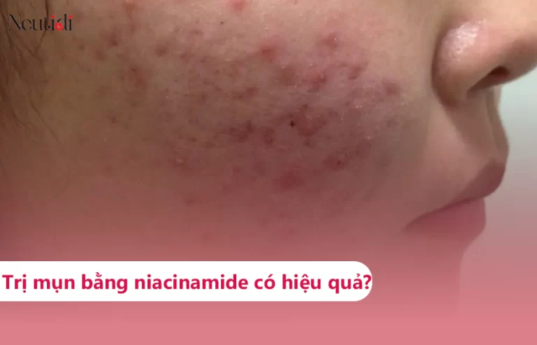 Niacinamide trị mụn được không?
