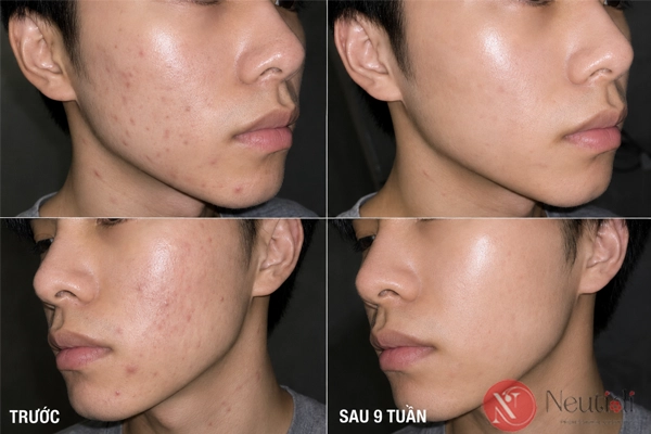 TOP 11 serum trị mụn cho da dầu tốt nhất 2026 (bác sĩ da liễu khuyên dùng) 14 Hiệu quả của serum neutidi Niacinamide - trị thâm mụn cho da dầu
