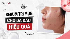 Serum trị mụn cho da dầu hiệu quả