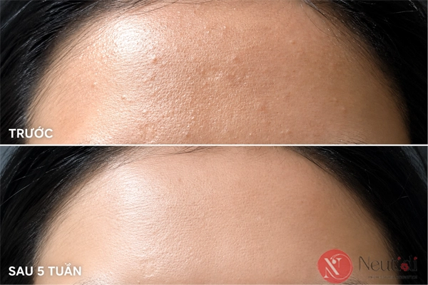 TOP 11 serum trị mụn cho da dầu tốt nhất 2026 (bác sĩ da liễu khuyên dùng) 6 review COSRX - serum hỗ trợ giảm mụn ẩn cho da dầu