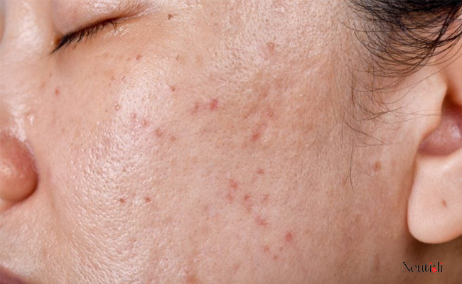 Vì sao da dầu cần sử dụng serum trị mụn riêng biệt