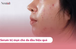 TOP 10 serum trị mụn cho da dầu hiệu quả nhất 2025