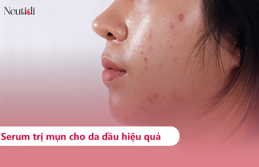TOP 10 serum trị mụn cho da dầu hiệu quả nhất 2025