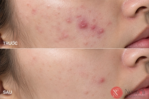 TOP 11 serum trị mụn cho da dầu tốt nhất 2026 (bác sĩ da liễu khuyên dùng) 10 La Roche-possay serum cho da mụn nhạy cảm - đánh giá chi tiết về hiệu quả