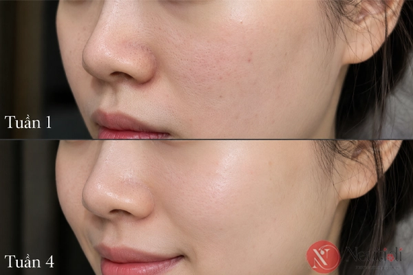 TOP 11 serum trị mụn cho da dầu tốt nhất 2026 (bác sĩ da liễu khuyên dùng) 3 Đánh giá serum trị mụn cho da dầu Paula's Choice