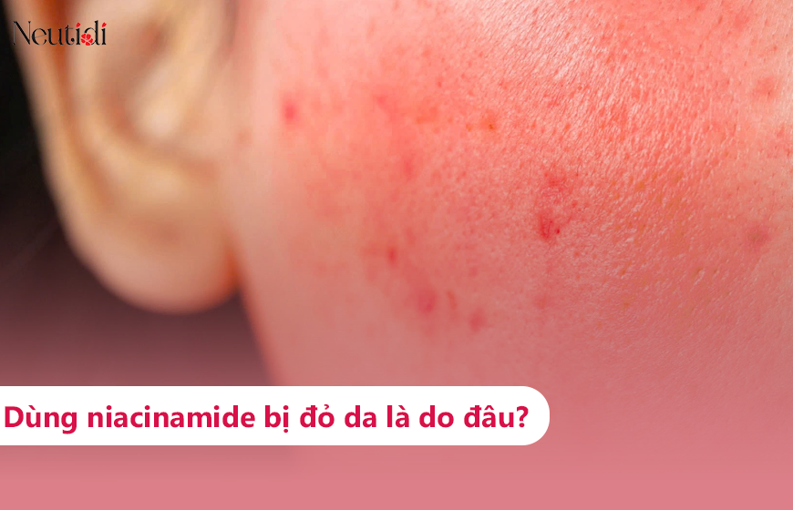 Tại sao dùng niacinamide bị đỏ da