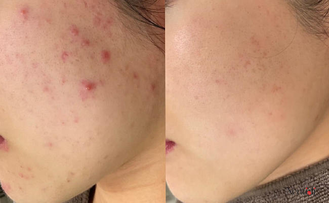 Trị mụn bằng niacinamide có hiệu quả không?