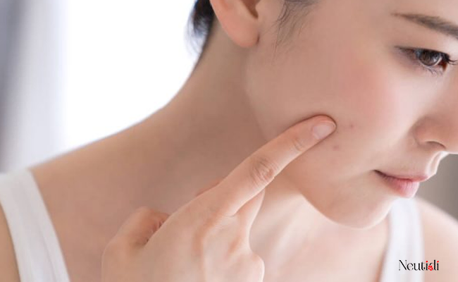 Ưu điểm khi sử dụng niacinamide trên da mụn