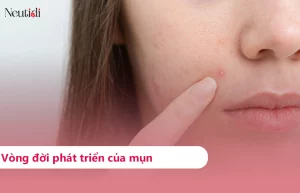 Các giai đoạn phát triển của mụn