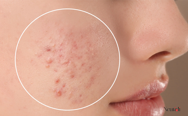 Top 10 thành phần trị mụn hiệu quả (không kê đơn & kê đơn) 2 Các loại mụn phổ biến hiện nay