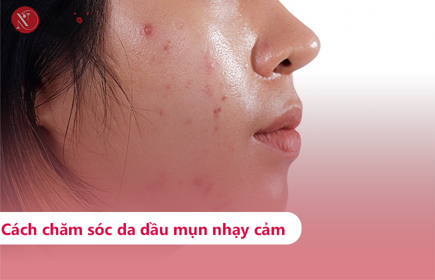 Hướng dẫn chăm sóc da dầu mụn nhạy cảm đúng cách 1 Cách chăm sóc da dầu nhạy cảm