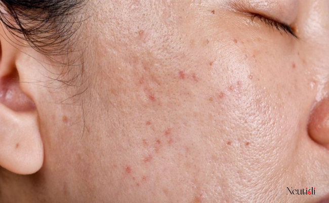 Hướng dẫn chăm sóc da dầu mụn nhạy cảm đúng cách 2 Tại sao cần phải chăm sóc da dầu nhạy cảm