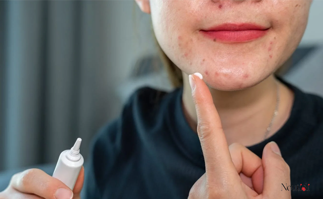 Cách chăm sóc da theo từng giai đoạn của mụn
