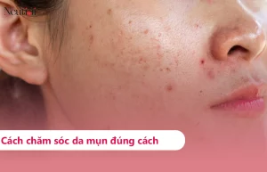 Quy trình các bước chăm sóc da mụn & lưu ý