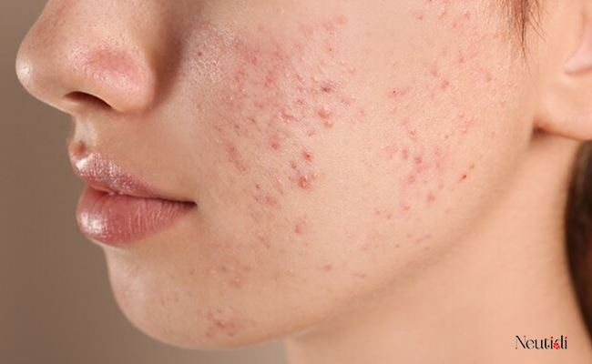 Lưu ý khi chăm sóc da mụn bị viêm