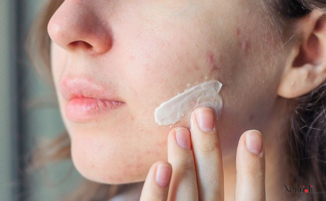 Chọn sản phẩm chứa salicylic acid
