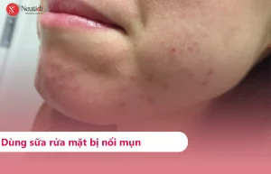 Nguyên nhân nổi mụn sau khi dùng sữa rửa mặt