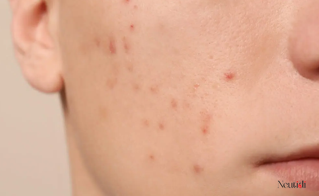 Những lưu ý khi chăm sóc da mụn