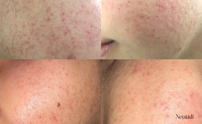 Tẩy tế bào chết quá mức có thể gây mụn