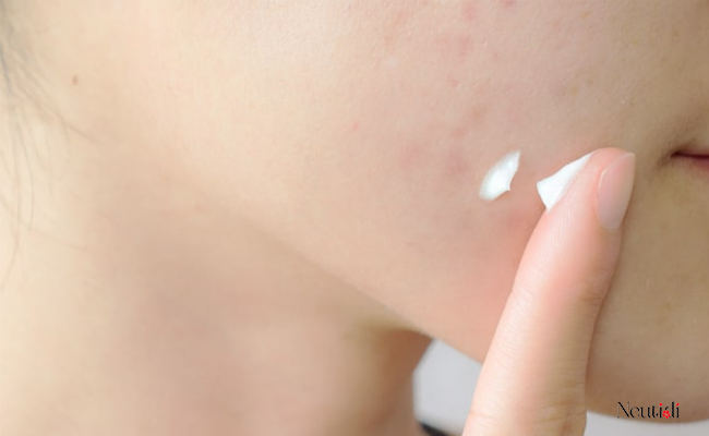 Top 10 thành phần trị mụn hiệu quả (không kê đơn & kê đơn) 3 Thành phần trị mụn Benzoyl Peroxide