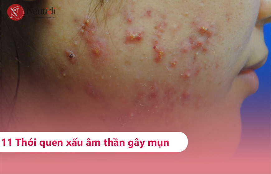 Những thói quen xấu gây mụn