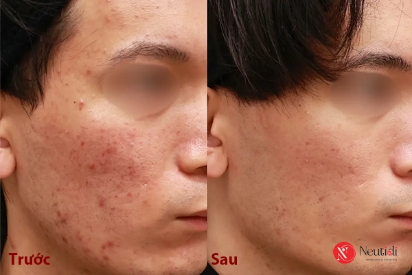 Cải thiện mụn - giảm viêm