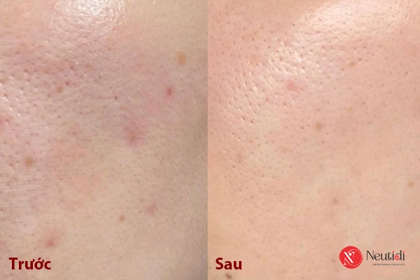 Cải thiện lỗ chân lông