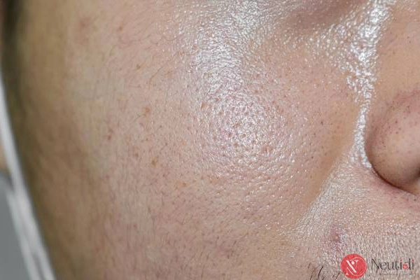 Hướng dẫn rửa mặt đúng cách cho da dầu (6 bước chi tiết) 2 Tìm hiểu về da dầu