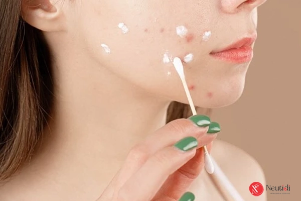 Bôi kem trị mụn bao lâu thì rửa mặt để da sạch mụn mà không kích ứng? 3 Dùng kem trị mụn buổi tối thì rửa lại mặt sau bao lâu