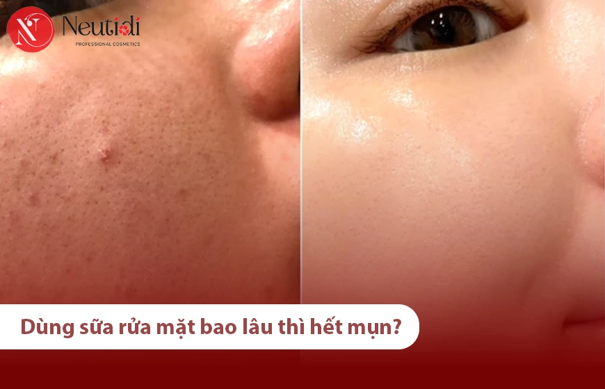 Giải đáp: Dùng sữa rửa mặt bao lâu thì hết mụn