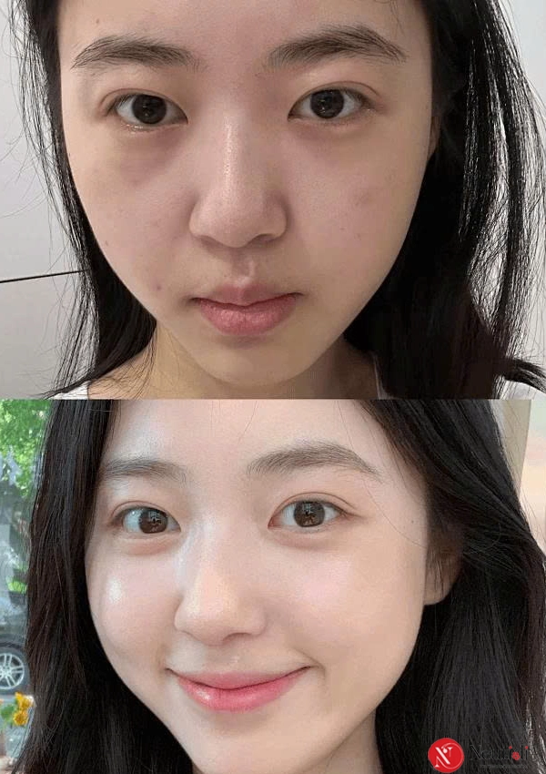 Làm mờ thâm mụn - làm sáng và đều màu da