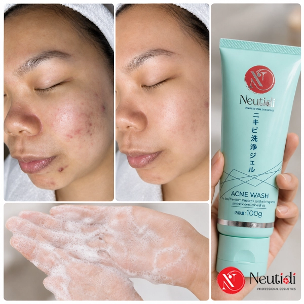 Sữa rửa mặt cho da dầu mụn - Neutidi Acne Wash