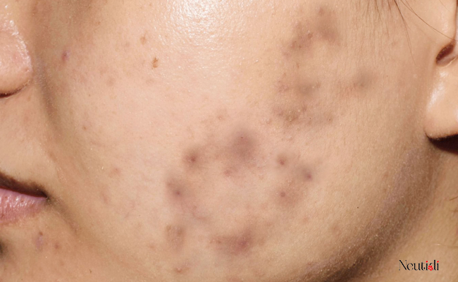 Niacinamide 10% có tác dụng gì? Cách dùng có gì khác biệt? 4 Niacinamide 10% làm mờ thâm mụn