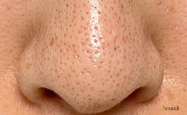 Niacinamide 10% có tác dụng gì? Cách dùng có gì khác biệt? 3 Niacinamide 10% giúp thu gọn lỗ chân lông