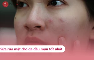 Sữa rửa mặt cho da dầu mụn