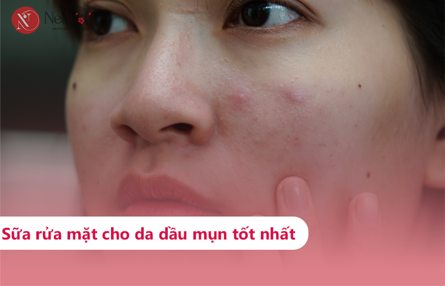 Sữa rửa mặt cho da dầu mụn