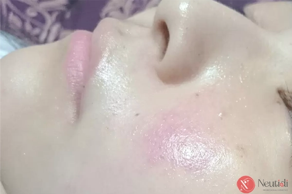 Rửa mặt bằng nước đá lạnh: Lợi ích, tác hại & cách thực hiện đúng chuẩn 4 Bỏng lạnh khi rửa mặt với nước đá lạnh