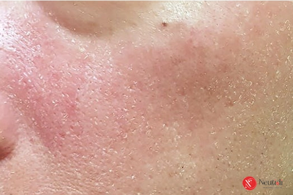 7 dấu hiệu nhận biết sữa rửa mặt không hợp da - thay đổi ngay kẻo muộn 3 Da đỏ, rát sau khi rửa mặt